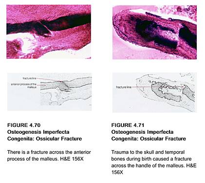 Pathologies de l'Oreille - Volume 4 : La Capsule Otique