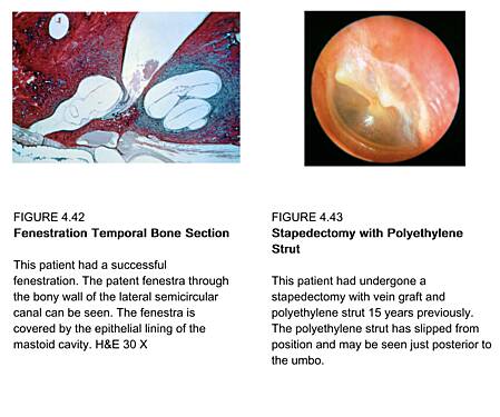 Pathologies de l'Oreille - Volume 4 : La Capsule Otique