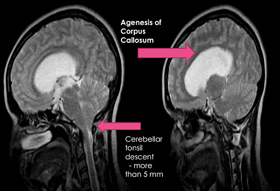 Ventriculostomie du Troisième Ventricule dans un Cas de Syndrome d'Aicardi Bénin avec Hydrocéphalie Obstructive