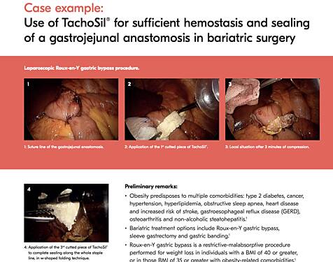 Utilisation de TachoSil® en Chirurgie Bariatrique pour une Hémostase et une Etanchéité Suffisantes lors de la Procédure de Pontage Gastrique Roux-en-Y