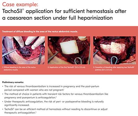 Application de TachoSil® pour une Hémostase Suffisante Après une Césarienne chez une Patiente Anticoagulée par Héparine