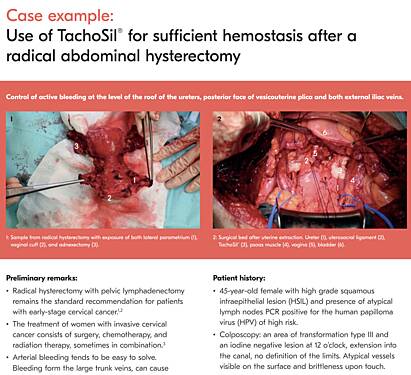 Utilisation de TachoSil® pour une Hémostase Suffisante après une Hystérectomie Totale