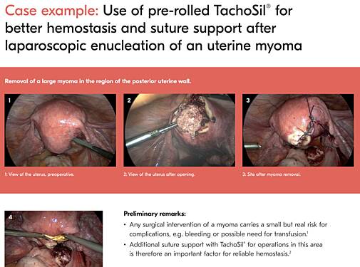 Utilisation de TachoSil® Pré-Enroulé pour une Meilleure Hémostase et un Meilleur Maintien des Sutures Après l'Enucléation Laparoscopique d'un Fibrome Utérin