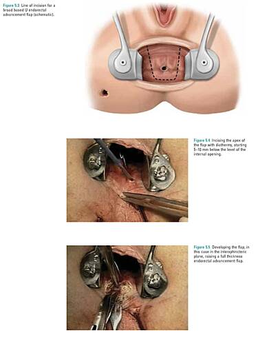 Chirurgie du côlon et rectale - opérations anorectales