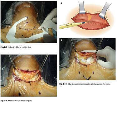 Atlas de la chirurgie thyroïdienne - procédures ouvertes, endoscopiques et robotiques