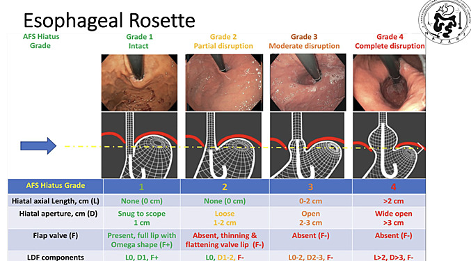 Rôle de l'Endoscopie Préopératoire en Chirurgie Bariatrique