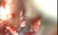 Kyste Epidermoïde de l'Angle Ponto-Cérébelleux - Ablation Microchirurgicale 