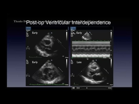 "Funky Motion" : Interprétation de Base et Avancée du Mouvement Septal en Echocardiographie