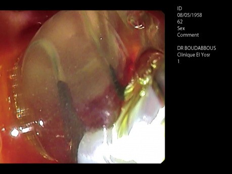 ERCP due à de gros dépôts solides dans le canal cholédoque.