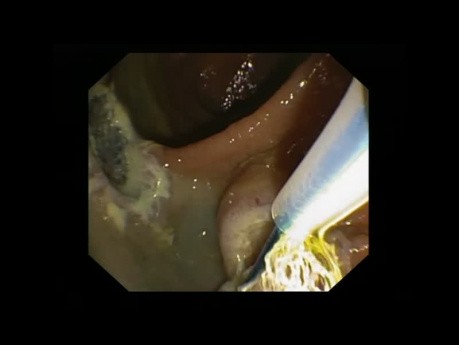 Exérèse de la papille duodénale majeure chez un patient atteint de PAF