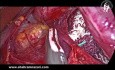 Le Rôle de la Libération des Adhérences Vago-Oesophagiennes pour Obtenir une Longueur Oesophagienne Distale Supplémentaire