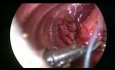 Réparation Thoracoscopique de Hernie Diaphragmatique Congénitale chez le Nouveau-Né