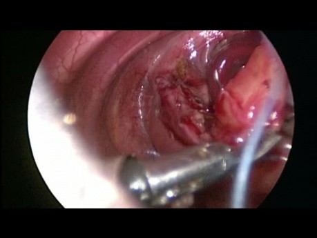 Réparation Thoracoscopique de Hernie Diaphragmatique Congénitale chez le Nouveau-Né