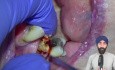 Exodontia for Beginners - Extraction Techniques - PS012