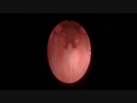 Image endoscopique de la gorge pendant l'amygdalectomie à l'aide du Boyle Davis Gag Set.