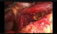 Fundoplicature de Nissen par voie laparoscopique