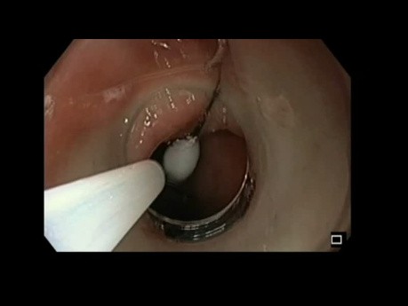 Extraction d'un corps étranger ( épingle) de l'estomac par voie endoscopique.