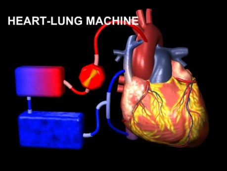 Animation de pontage aorto-coronaire