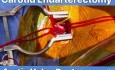 Remplacement Valvulaire Aortique + Endartériectomie Carotidienne Droite