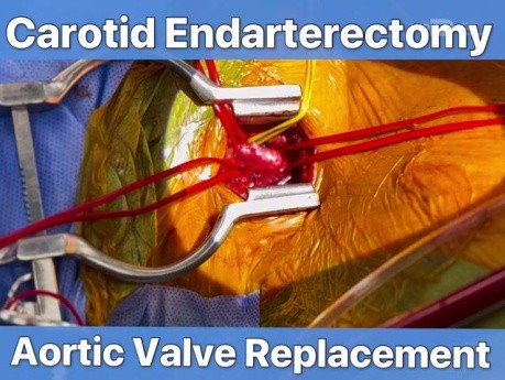 Remplacement Valvulaire Aortique + Endartériectomie Carotidienne Droite