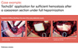 Application de TachoSil® pour une Hémostase Suffisante Après une Césarienne chez une Patiente Anticoagulée par Héparine
