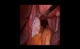 Grossesse extra-utérine tubaire - prise en charge laparoscopique