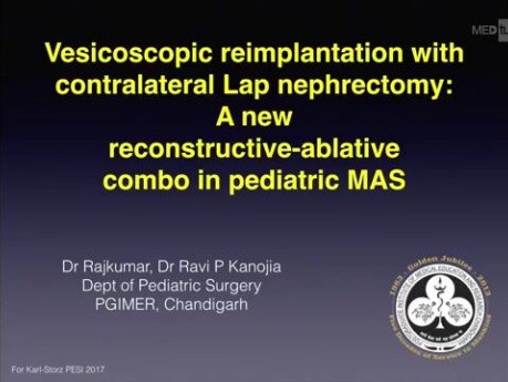 Réimplantation laparoscopique avec néphrectomie: l'intervention dans le syndrome d'activation macrophagique chez l'enfant