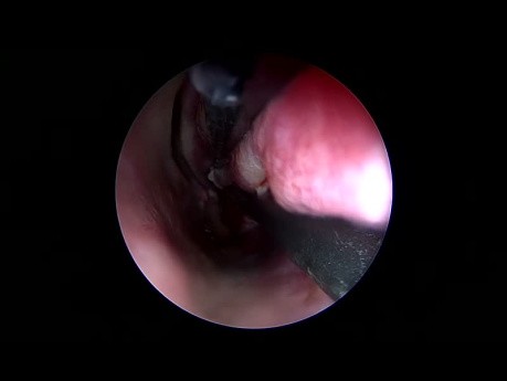 Turbinoplastie par Radiofréquence