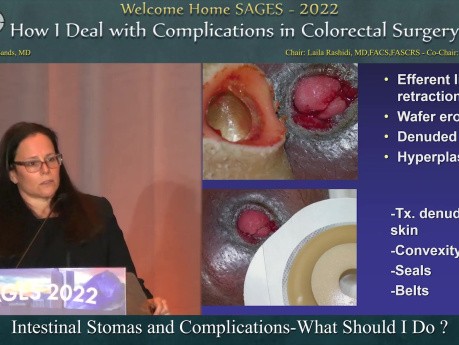 Stomies Intestinales et Complications - Conduite A Tenir 