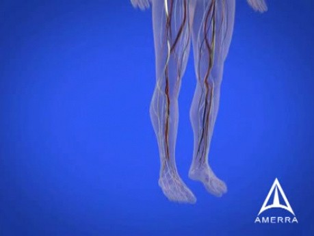 Éducation sur le diabète - L'animation médicale 3D