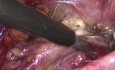 La lymphadénectomie pelvienne étendue laparoscopique