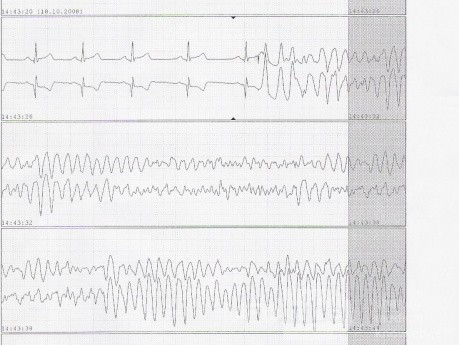Fibrillation ventriculaire causée par hyposensibilité de la sonde ventriculaire de la stimulation temporaire