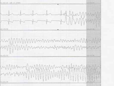 Fibrillation ventriculaire causée par hyposensibilité de la sonde ventriculaire de la stimulation temporaire