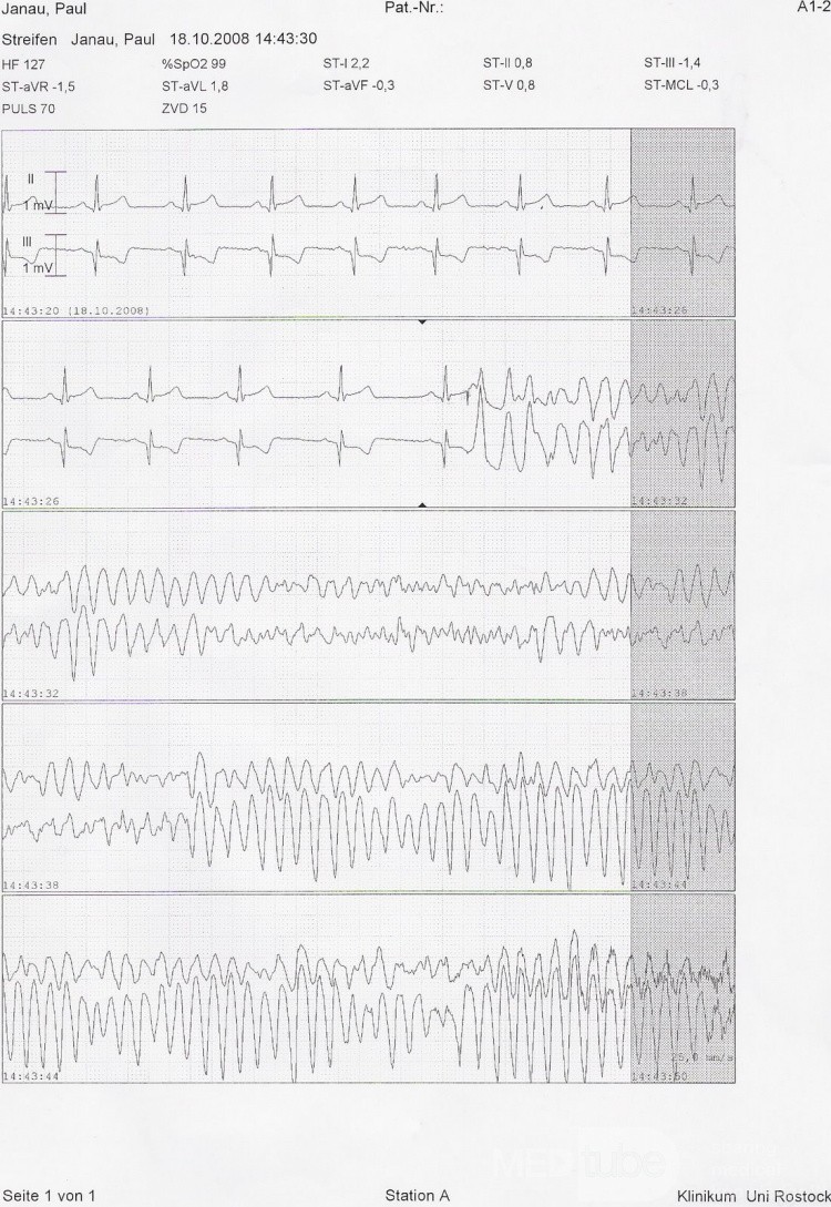 Fibrillation ventriculaire causée par hyposensibilité de la sonde ventriculaire de la stimulation temporaire
