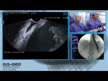 Drainage sous contrôle de l'échographie endoscopique (EUS)