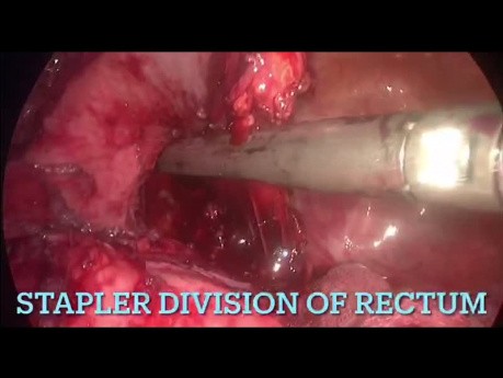 Prise en charge laparoscopique de la structure colorectale post-anastomotique