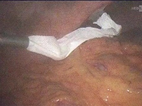 Cas de Cholécystectomie Laparoscopique Difficile : je Souhaite Connaître Votre Avis sur ce Cas.