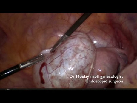 Cystectomie Ovarienne avec Préservation de la Fertilité