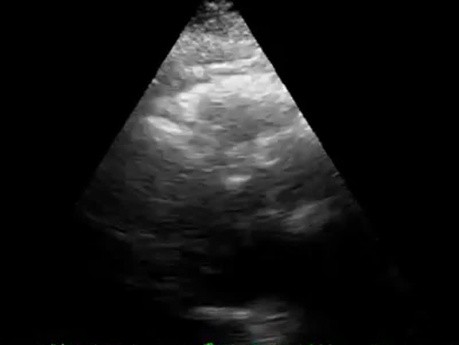 Echographie cardiaque parasternale long axe. Fonction contractile normale - fibrillation auriculaire