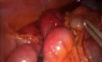 Occlusion sur bride: traitement cœlioscopique.