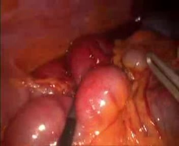 Occlusion sur bride: traitement cœlioscopique.