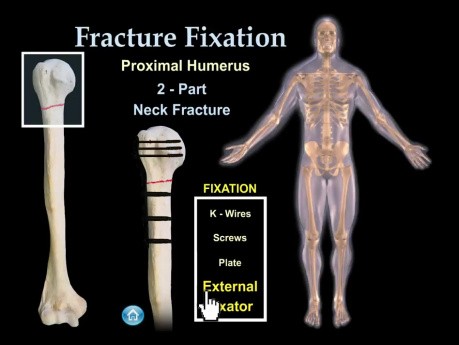 Techniques chirurgicales du traitement des fractures - animation