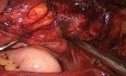 Kyste de l'ovaire endométriosique bilatérale