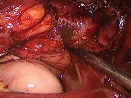 Kyste de l'ovaire endométriosique bilatérale
