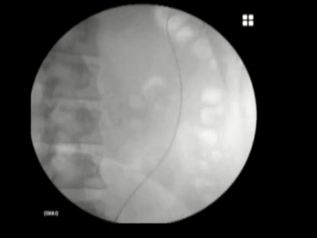Obstruction urétérale - Pose d'une endoprothèse