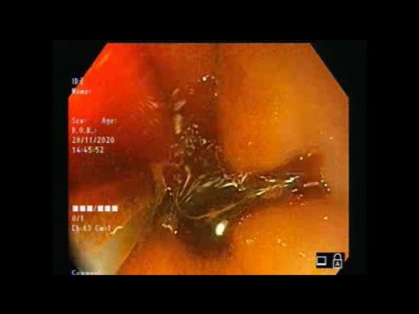 Endoscopie à lumière blanche vs Chromoendoscopie (Lugol) vs NBI