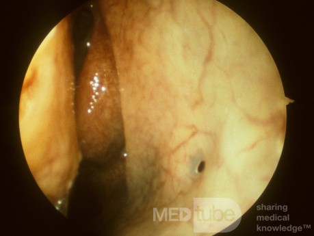 Accessoire Ostium du sinus maxillaire [petit]