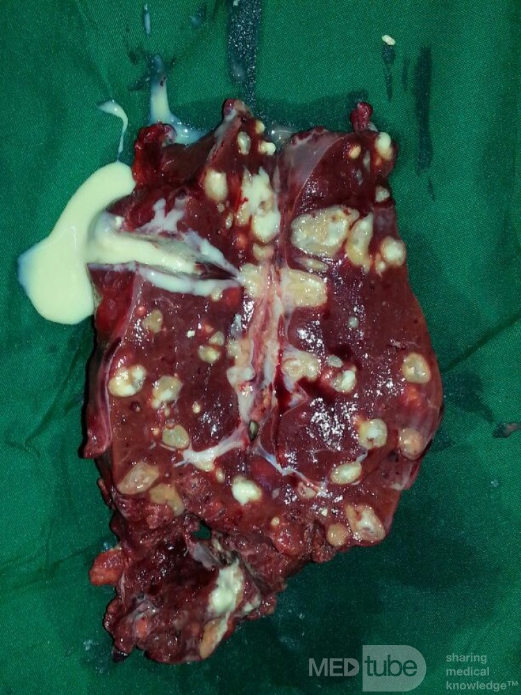 La tuberculose splénique.