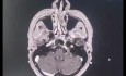 Approche Supra/Para-Condylienne pour la Résection d'une Tumeur du Glomus Jugulaire