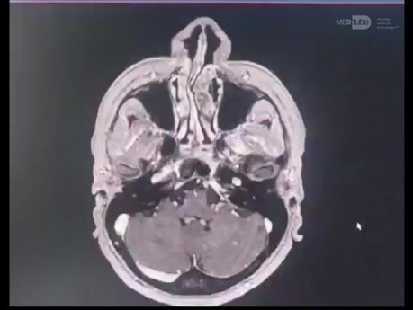 Approche Supra/Para-Condylienne pour la Résection d'une Tumeur du Glomus Jugulaire